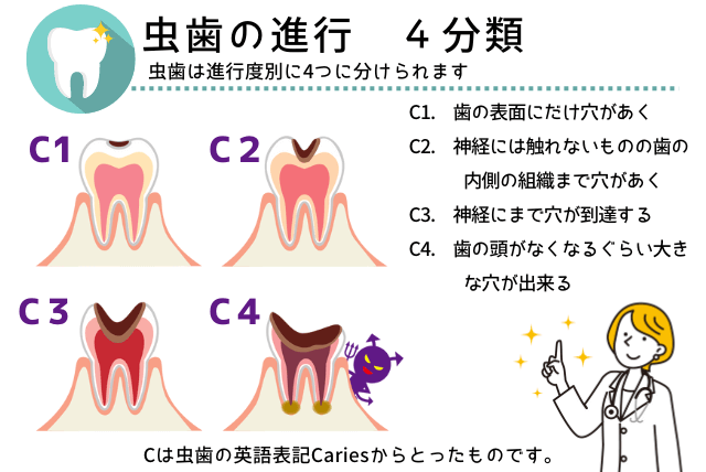 虫歯の進行 ４分類