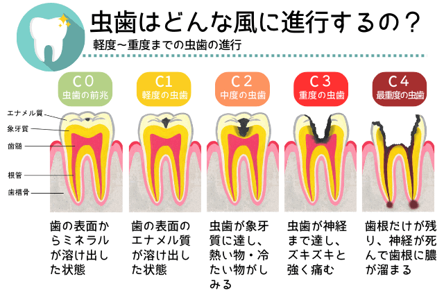 虫歯の進行