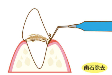 歯石