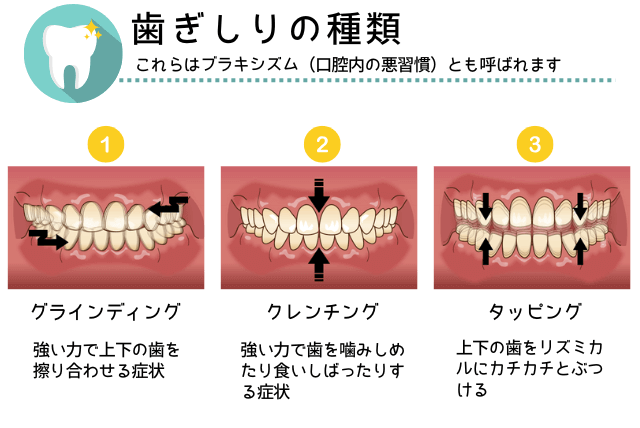 歯ぎしりの種類